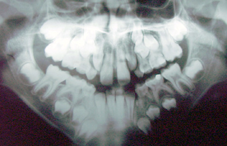 Incisivos tomando lugar dos caninos-1