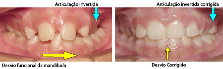 Incisivos tomando lugar dos caninos-3