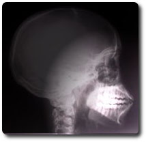 PROBLEMAS NA ARTICULAÇÃO TEMPOROMANDIBULAR