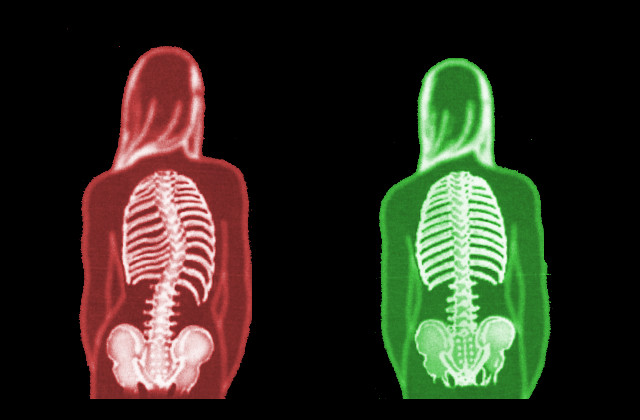 ESCOLIOSE -  O Diagnóstico Precoce Ajuda | ABC da Saúde